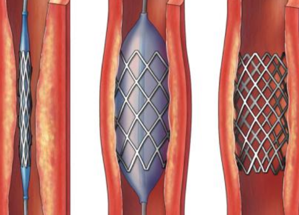 好消息！700元冠脈支架來了帶量采購結(jié)果在甘肅省正式落地執(zhí)行